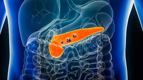 artificial prostate cancer scan