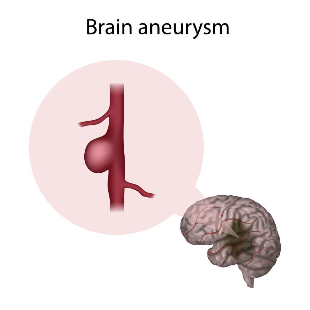 aneurysms