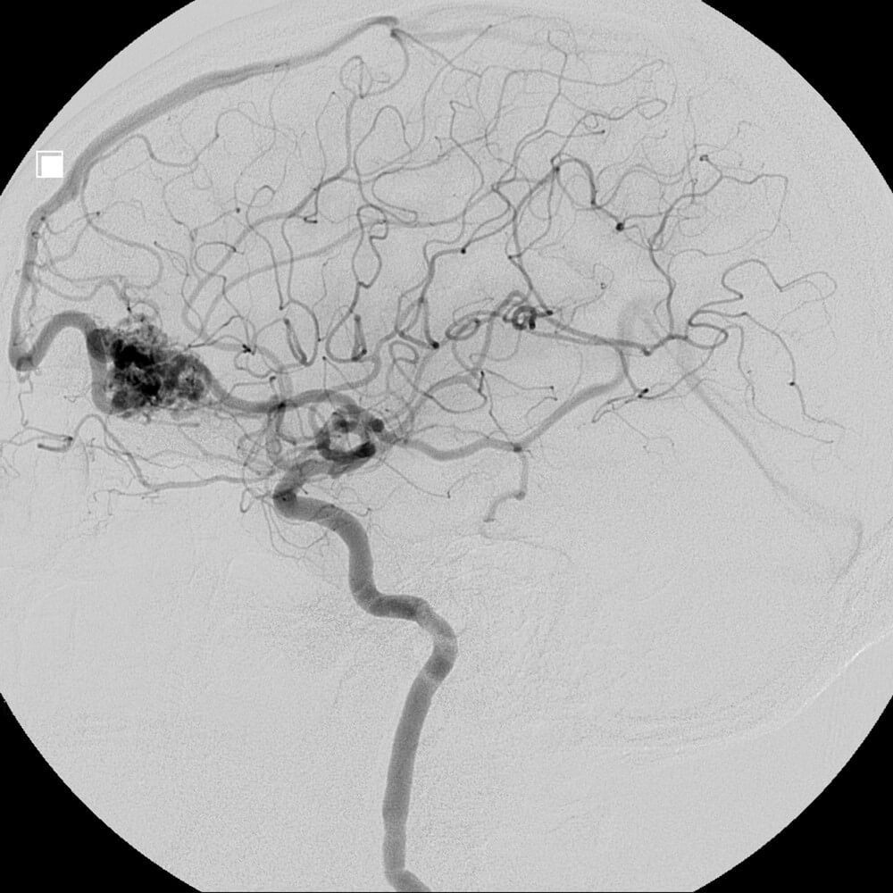 Arteriovenous malformation