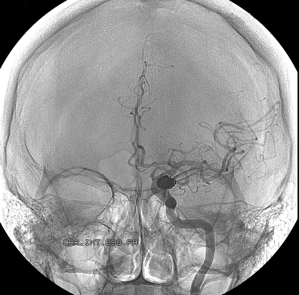 Embolization for Treating Aneurysm