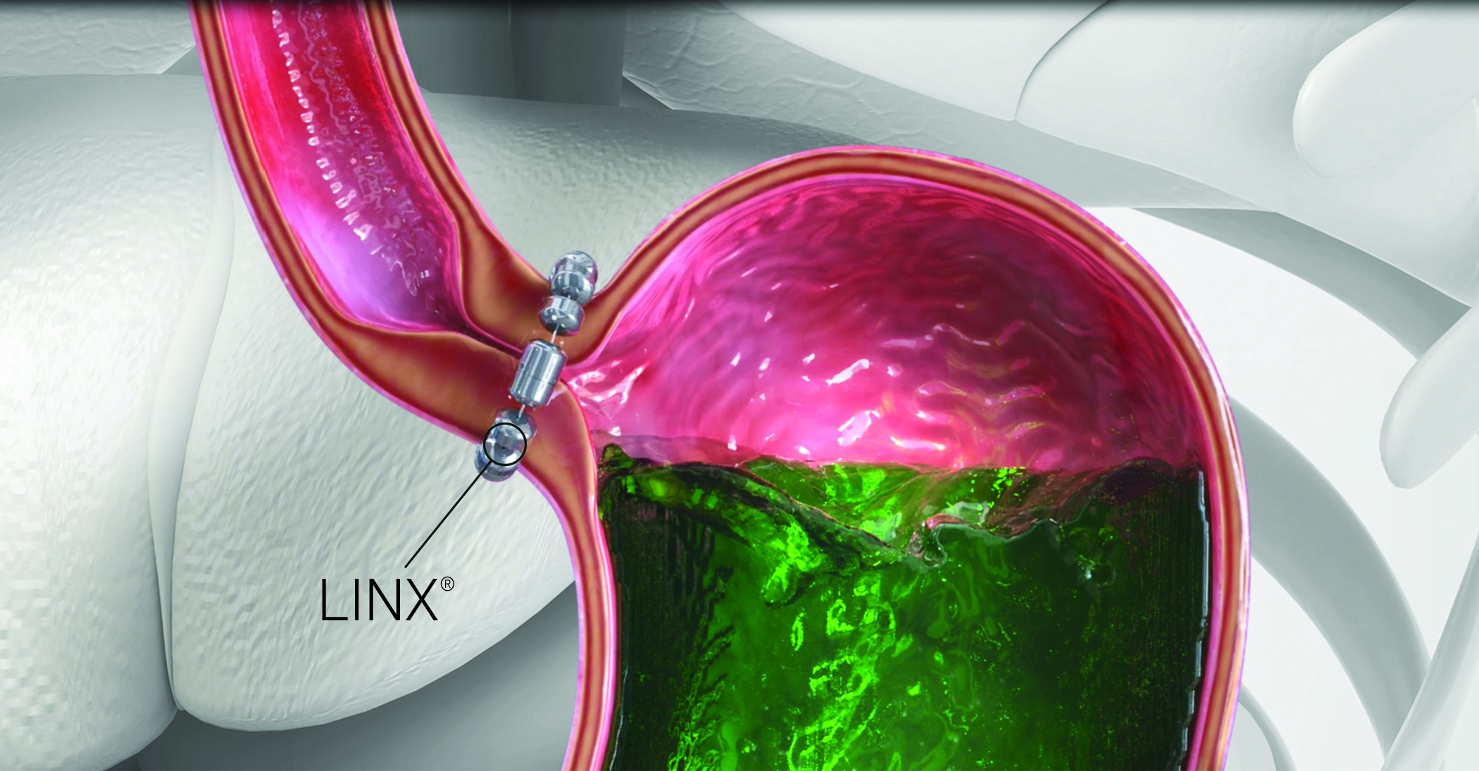 LINX Reflux Management System